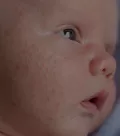 Causas del acné neonatal